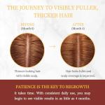 Advanced Minoxidil Hair Growth Serum, 2% Minoxidil Topical Solution for Women, Hair Regrowth Treatment for Thinning & Hair Loss, Thicker Fuller Hair, Non-Greasy with Biotin Rosemary Caffeine Ginseng