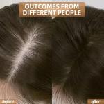 Red Light Therapy for Hair Growth, Laser Hair Loss Treatments Hat, Discreet Daily Use Under Hats, 20-min Rechargeable