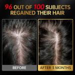 Minoxidil for Men & Women, With Biotin, Batana Oil, Rosemary Essential Oil, Effective Hair Loss Solution, Hair Loss Treatment for Hair Regrowth, Non-Greasy 5% Minoxidil - 60ml(Single Bottle Serum)