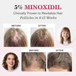 5% Minoxidil for Women Hair Regrowth Spray, hers hair regrowth treatment Infused with Biotin, Extra Strength Treatment to Combat Hair Loss and Thinning, 3 Bottles