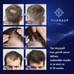 5% Minoxidil Hair Growth for Men and Women: Extra Strength Minoxidil Topical Solution for Adults with Receding Hairlines or Vertex Thinning - Hair Loss Treatment Serum with Biotin for Daily Scalp Use