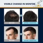 5% Minoxidil Hair and Beard Growth Kit: Extra Strength Minoxidil Topical Hair Regrowth Treatments Serum for Thinning Hair - Hair Loss Products for Men and Women