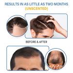 5% Minoxidil Foam for Men & Women Hair Regrowth, Fast-Absorbing Lightweight Minoxidil Treatment for Thinning Hair, Receding Hairline & Balding, Non-Greasy Unscented Hair Growth Foam