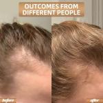 Red Light Therapy for Hair Growth, Quick-Release Panels & Portable Design, Laser Hair Growth Cap, Hair Loss Treatments Hat