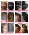 Tru Bloom Hair Growth Vitamins - 2 Month Supply
