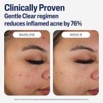 Vegan Mattifying Face Moisturizer for Acne-Prone Skin