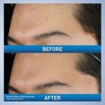 Vegan Acne Foaming Cleanser with Benzoyl Peroxide