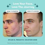 Vegan 3-Step Acne Treatment Kit for Clear Skin