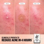 Vegan Acne Healing Dots for Quick Blemish Relief