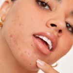 Vegan Acne Healing Dots for Quick Blemish Relief