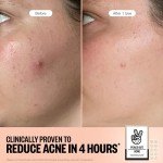 Vegan Acne Healing Dots for Quick Blemish Relief