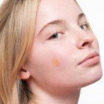 Vegan Acne Healing Dots for Quick Blemish Relief