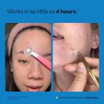 Vegan Acne Spot Dots - Hydrocolloid Pimple Patches