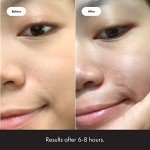 Hero Cosmetics Vegan Acne Patch - 36 Count