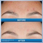 Vegan Brightening Retinol Serum for Acne Scars