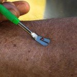 TickCheck Tick Remover Kit with Tweezers & Case