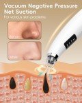 Blackhead Remover Vacuum with 3 Suction Levels