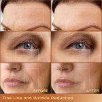 MLAY RF Beauty Machine for At-Home Skin Tightening