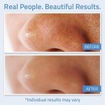 YEOUTH 20% Salicylic Acid Face Peel Exfoliator