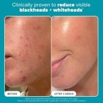 Paula's Choice 2% BHA Liquid Exfoliant, 4 oz