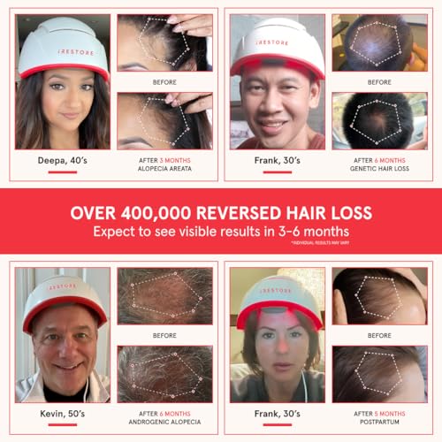 iRestore Laser Hair Growth System for Men & Women