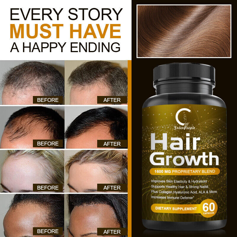 DHT Blocker Capsules for Rapid Hair Growth