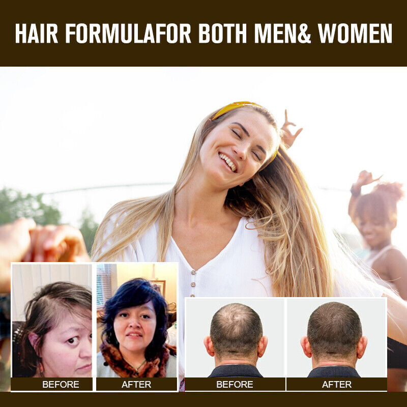 DHT Blocker Capsules for Rapid Hair Growth