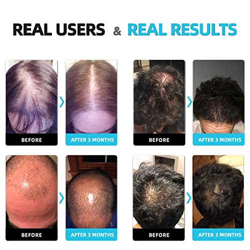 iHelmet Laser Hair Growth System for All