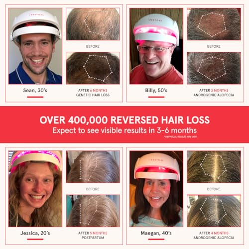 iRestore Laser Hair Growth System for Men & Women
