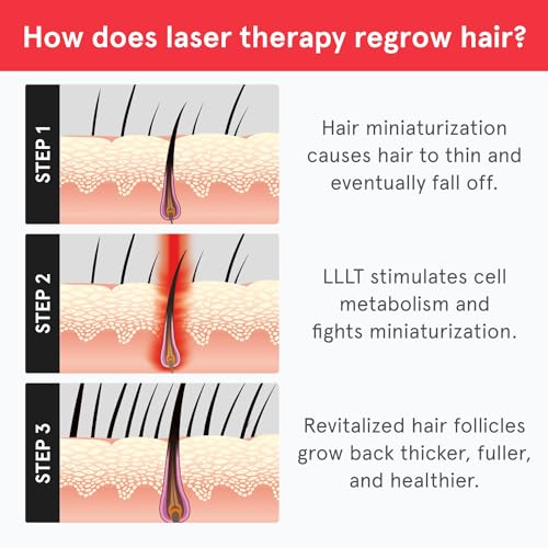iRestore Laser Hair Growth System for Men & Women