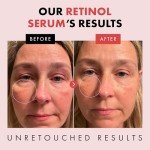 Eclat Skincare Retinol Serum with Hyaluronic Acid