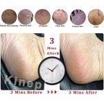 Kinepi Callus Remover Foot Scrubber Colossal Foot File Foot Care and Foot Exfoliator Foot Rasp Pedicure Tools Pumice Stone for Feet,Remove Corn Hard Skin Dead Skin for Use in Shower Foot Scraper Kit