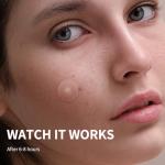 Daolyo Pimple Patches for Face, 4 Size 300 Counts Acne Patches, Hydrocolloid Patches for Covering Zits and Blemishes, Spot Stickers with Salicylic Acid, Tea Tree Oil & Calendula Oil