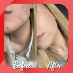 Kollo Premium Marine Liquid Collagen, 10,000 mg with Hyaluronic Acid, 14 x 10000mg Hydrolysed Collagen Peptides Sachets, Liquid Collagen Supplements Vitamins B & C, Informed Sport Certified