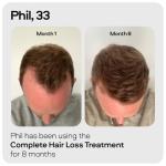 Sons Hair Growth Shampoo for Men. DHT Blocker. Thickening Formula Promotes Strong & Thick Regrowth. Contains Saw Palmetto, Argan Oil, Caffeine, & Rosemary. 3 Month Supply. Made in Europe.