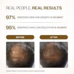 Bare Anatomy Advanced Roll-On 3% Redensyl + 4% Anagain + 2% Baicapil + 5% Rosemary, Rice Water, Biotin & Saw Palmetto Reduces Hair Fall, Supports Hair Growth Hair Growth Serum 25 ml