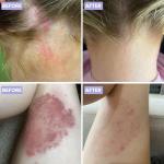 Natural Relief Cream for Psoriasis on Skin