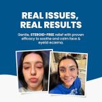 Natural Eczema Cream for Face and Eyelids