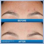 CeraVe Retinol Serum for Acne Marks and Brightening