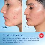 Differin Retinoid Acne Treatment Gel for Sensitive Skin