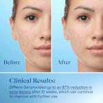 Differin Acne Treatment Gel - 2 Pack