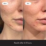 Mighty Patch Invisible Acne Pimple Patches
