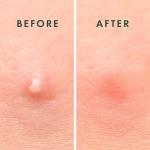 Rael Invisible Acne Patches for Spot Treatment