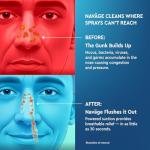 Navage Starter Bundle: Nasal Irrigation & Rinse Kit