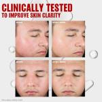 Thayers Acne Treatment Toner with Salicylic Acid