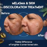 Melasma Treatment Cream for Dark Spots and Scars