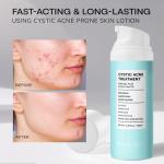 BellamiLuxx Acne Treatment Cream with Salicylic Acid