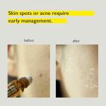 Teatree Oil Roll-On for Acne Spot Care