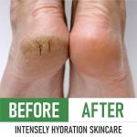 Intensive 40% Urea Foot Cream for Dry Heels