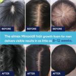 5% Minoxidil Foam for Hair and Beard Growth